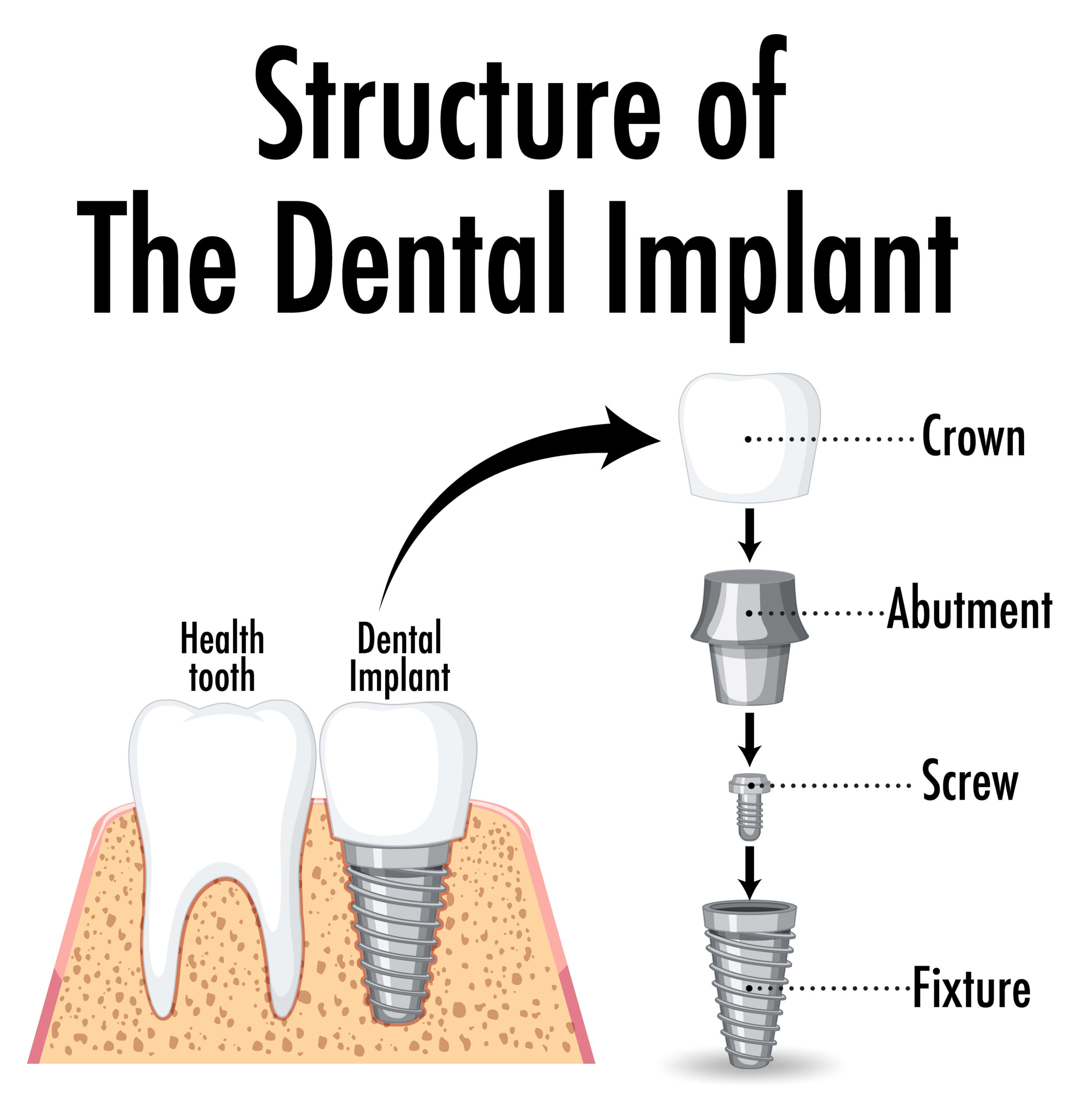 An implant consultation at Millway Dental.