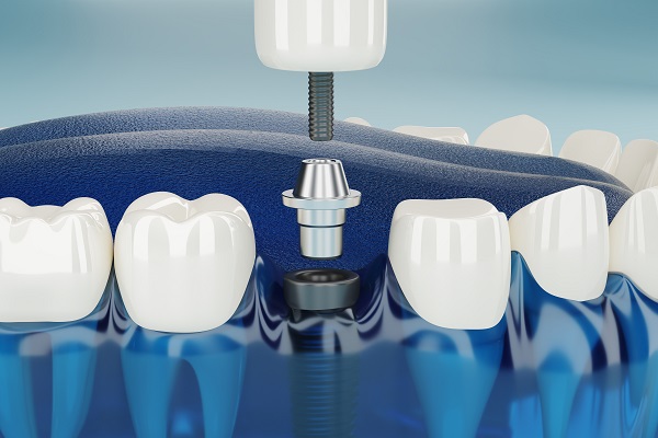 The titanium post and crown that make up a dental implant.